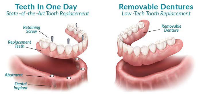 snap in dentures vs implants
