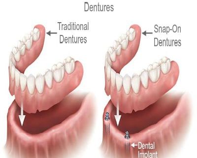 snap in dentures